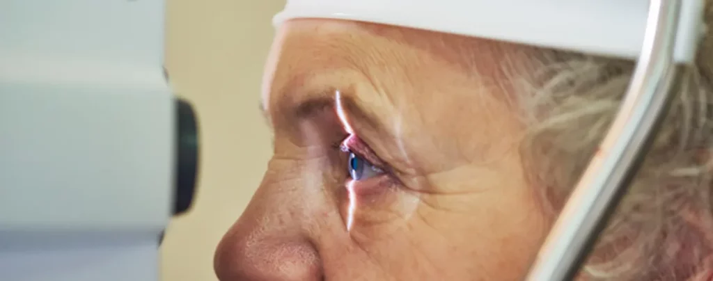 मोतियाबिंद (Cataract): लक्षण, कारण और उपचार