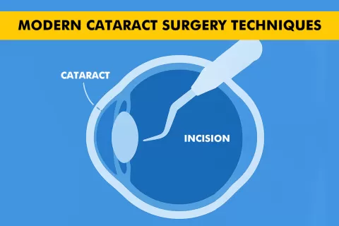 Cataract Surgery – How To Choose The Best Eye Care Center?