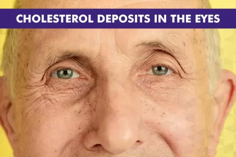 Cataract Surgery – How To Choose The Best Eye Care Center?