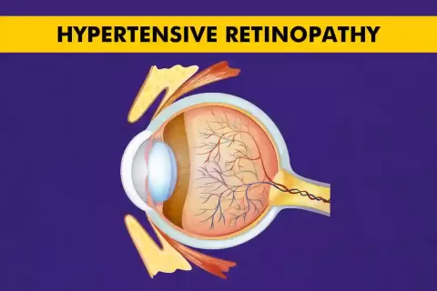 Cataract Surgery – How To Choose The Best Eye Care Center?