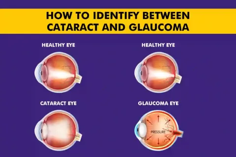 Cataract Surgery – How To Choose The Best Eye Care Center?
