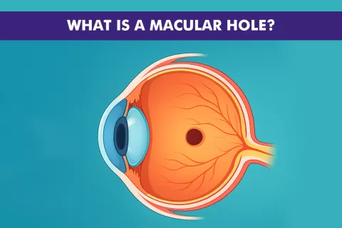 Cataract Surgery – How To Choose The Best Eye Care Center?