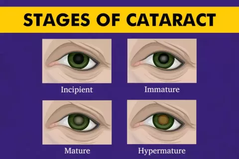 Cataract Surgery – How To Choose The Best Eye Care Center?