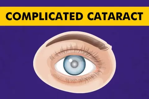 Cataract Surgery – How To Choose The Best Eye Care Center?
