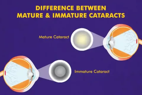 Cataract Surgery – How To Choose The Best Eye Care Center?
