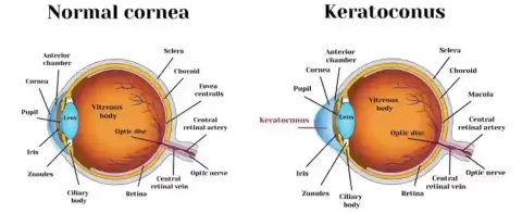 Cataract Surgery – How To Choose The Best Eye Care Center?
