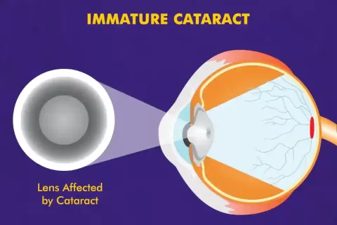 Cataract Surgery – How To Choose The Best Eye Care Center?