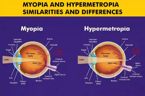 Cataract Surgery – How To Choose The Best Eye Care Center?