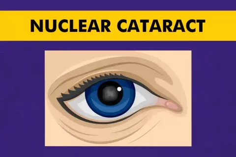 Cataract Surgery – How To Choose The Best Eye Care Center?