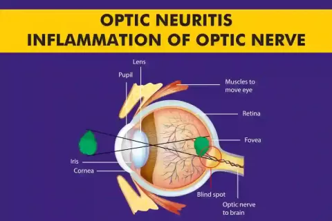 Cataract Surgery – How To Choose The Best Eye Care Center?