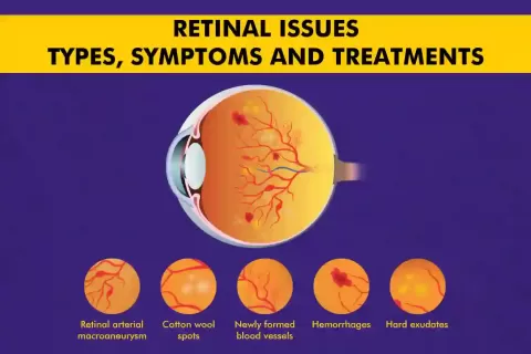 Cataract Surgery – How To Choose The Best Eye Care Center?