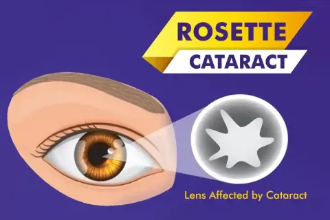 Cataract Surgery – How To Choose The Best Eye Care Center?
