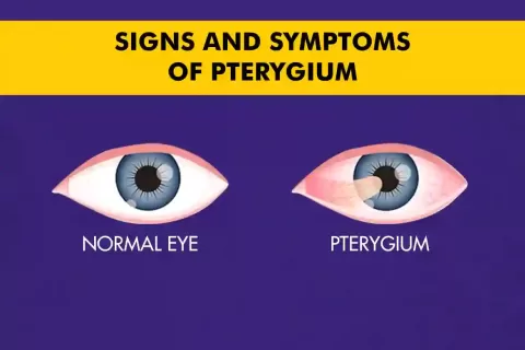 Cataract Surgery – How To Choose The Best Eye Care Center?