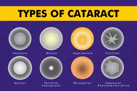 Cataract Surgery – How To Choose The Best Eye Care Center?