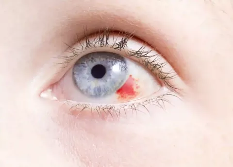 Cataract Surgery – How To Choose The Best Eye Care Center?