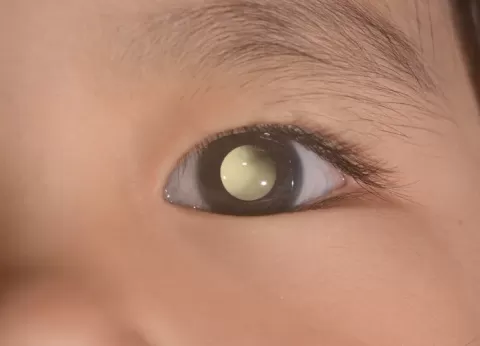 Cataract Surgery – How To Choose The Best Eye Care Center?