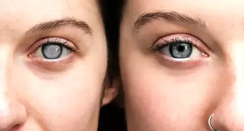 Cataract Surgery – How To Choose The Best Eye Care Center?